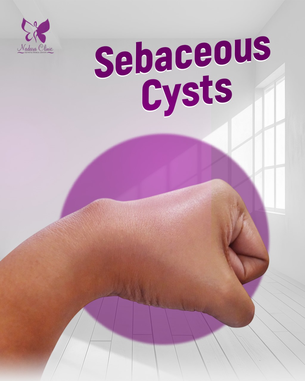 sebaceous cysts